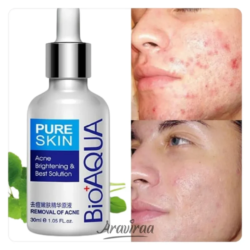 Anti acne and anti inflammatory serum Arv 140116 1 | فروشگاه اینترنتی آراویرا