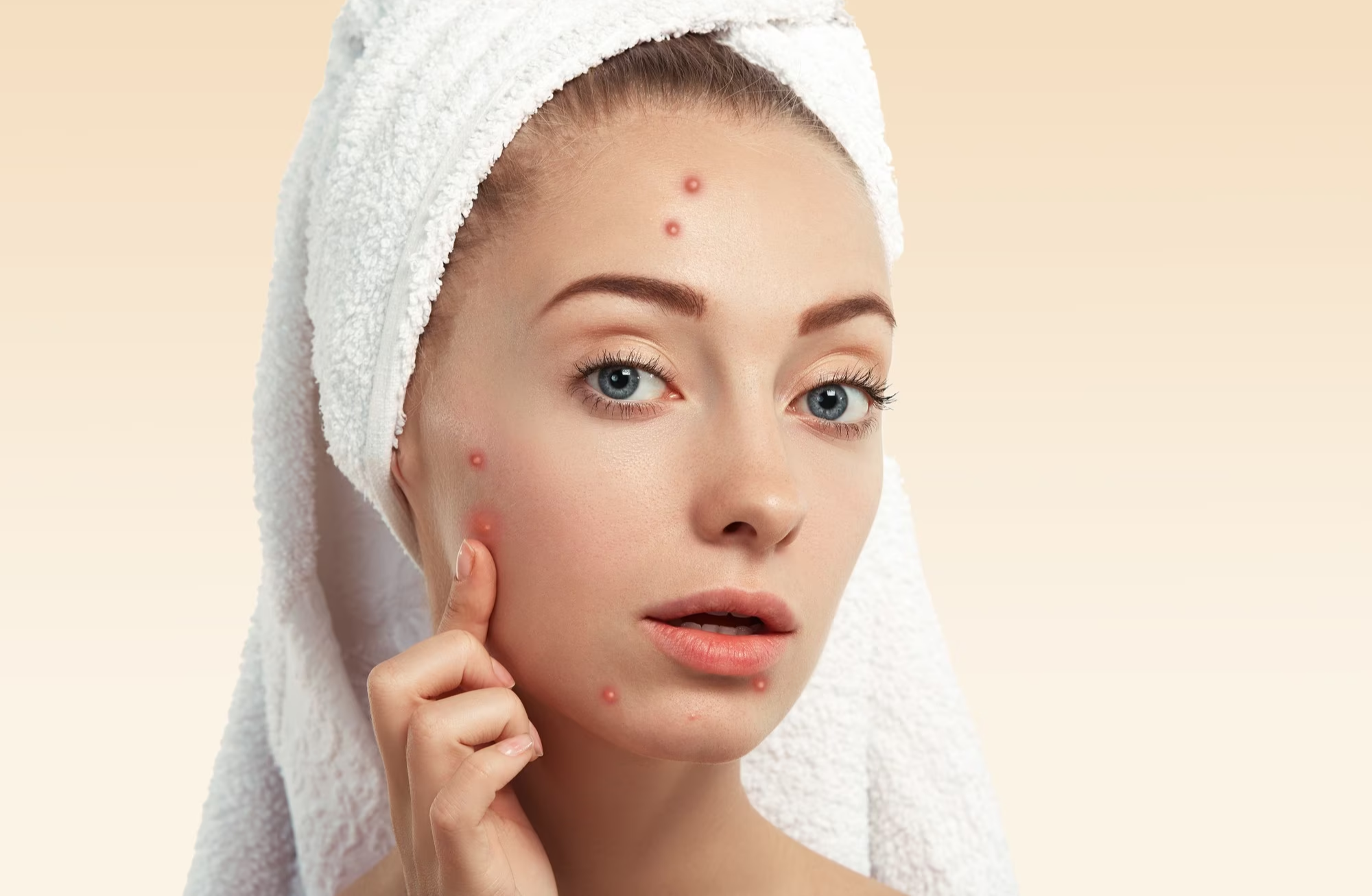 جوش های درشت روی صورت زن - از بین بردن جوش صورت