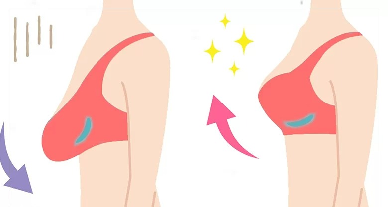 برطرف کردن مشکل افتادگی پستان - درمان افتادگی سینه