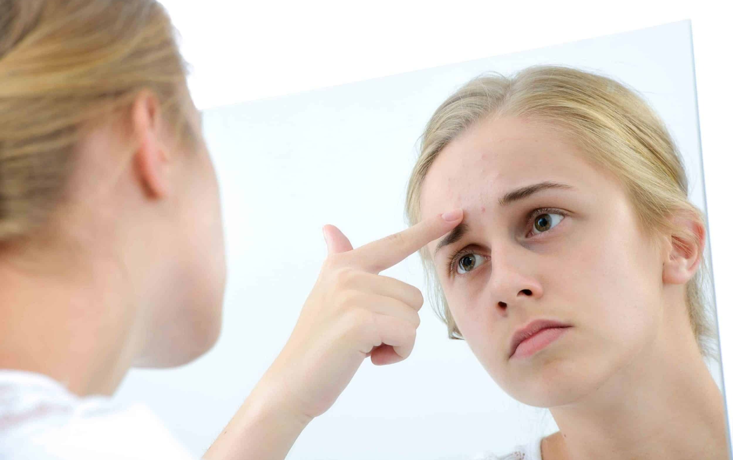 جوش پیشانی - از بین بردن جوش صورت