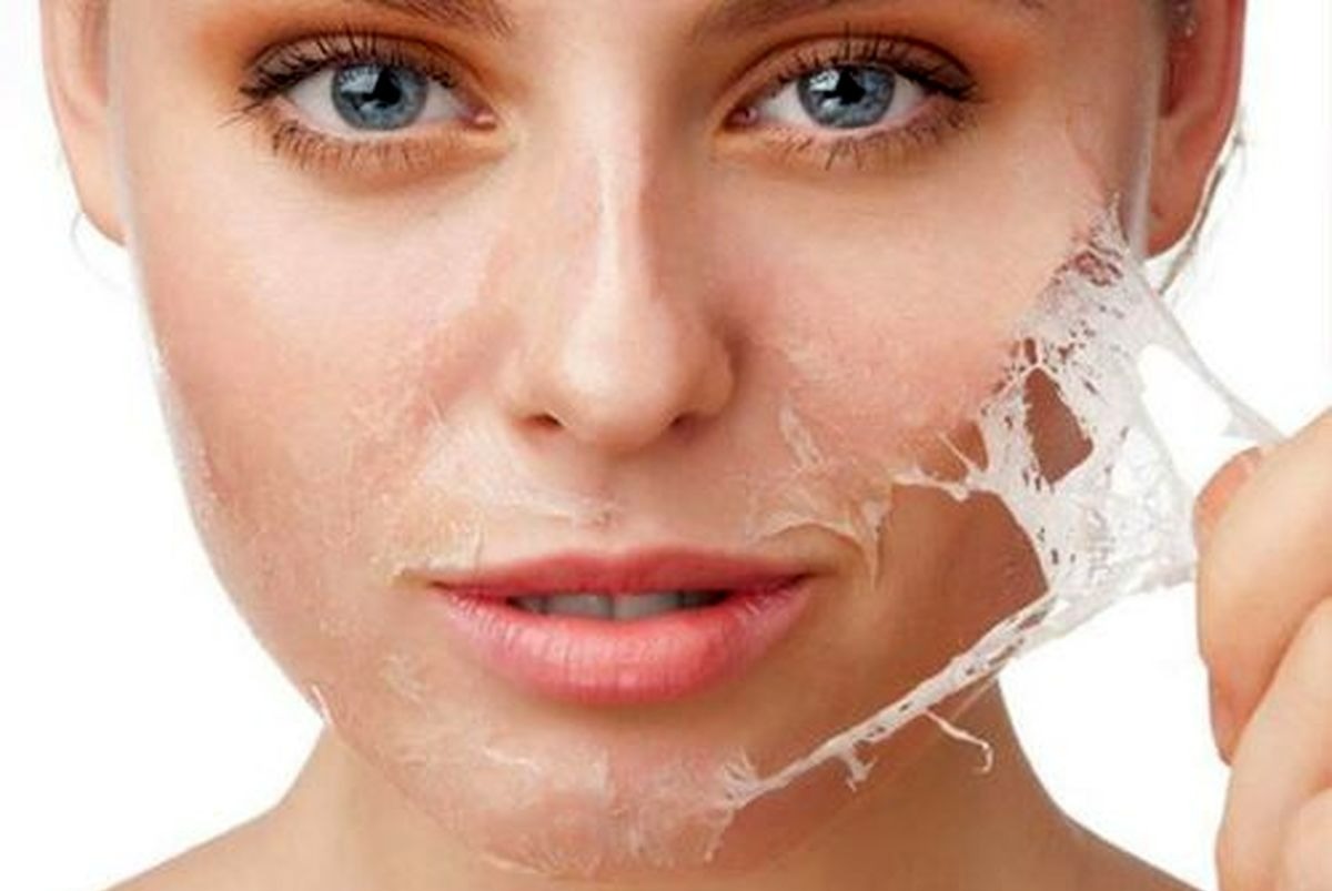 لایه برداری - از بین بردن لک صورت