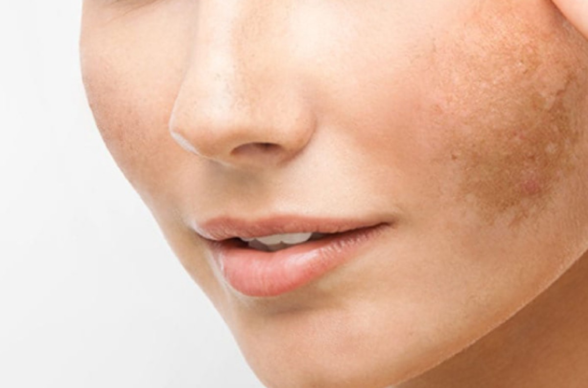 لک صورت بارداری - از بین بردن لک صورت