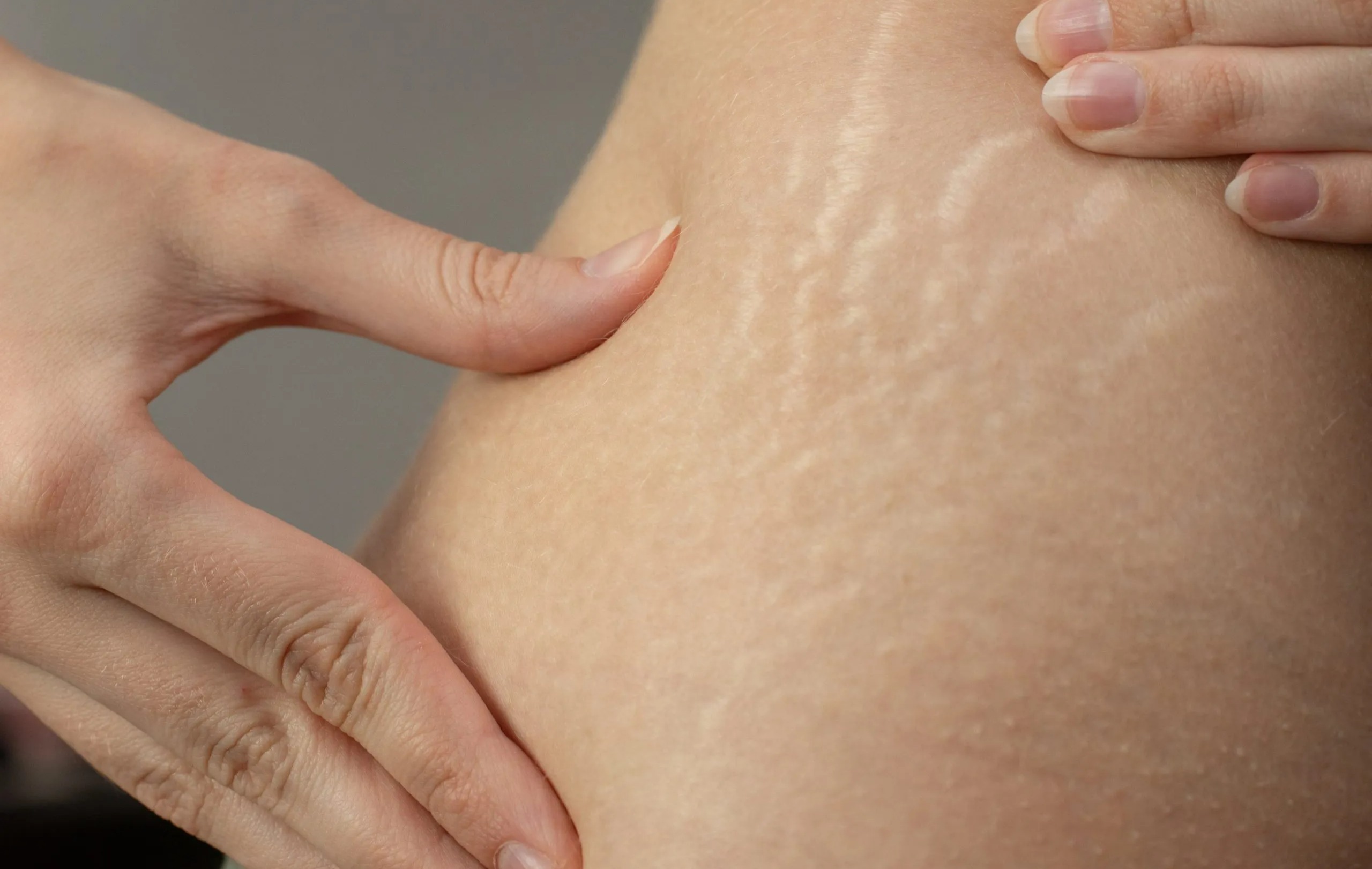 ترک های پوستی بارداری - درمان ترک پوستی