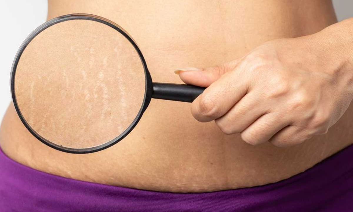 ترک های سفید روی پوست - درمان ترک پوستی