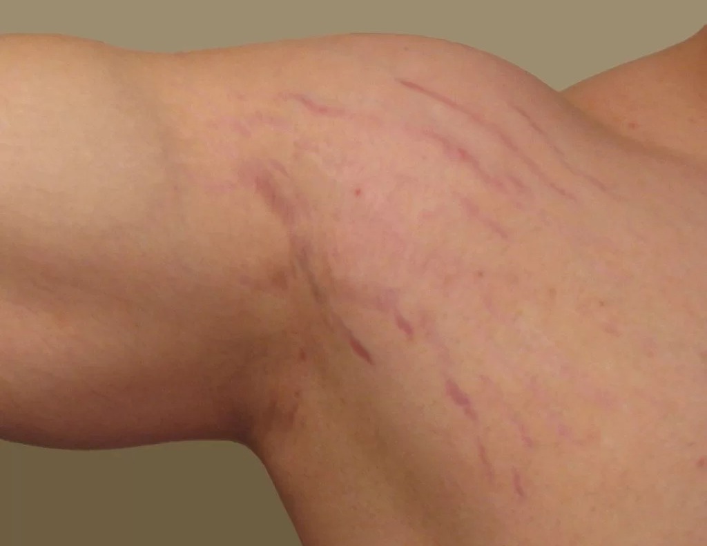 ترک روی بازو - درمان ترک پوستی