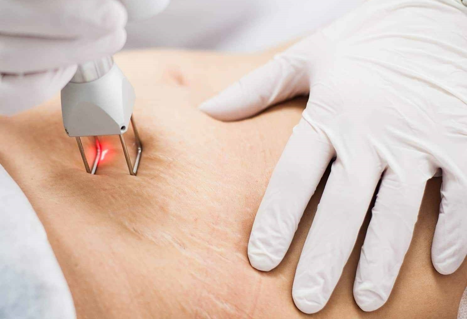 لبزر رفع ترک پوست - درمان ترک پوستی