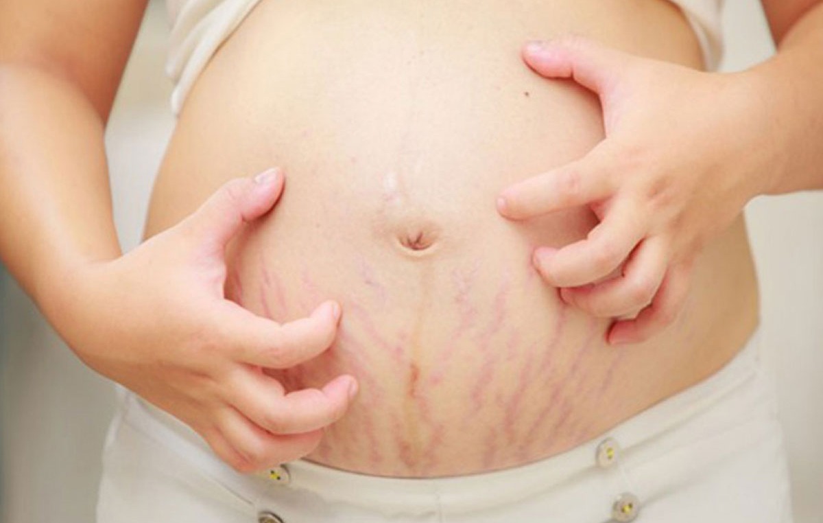 خارش ترک شکم - درمان ترک پوستی