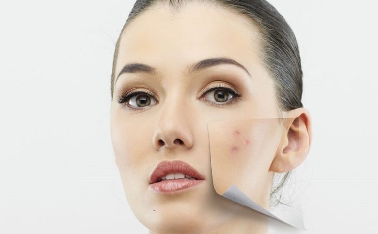 درمان خانگی لک های پوستی