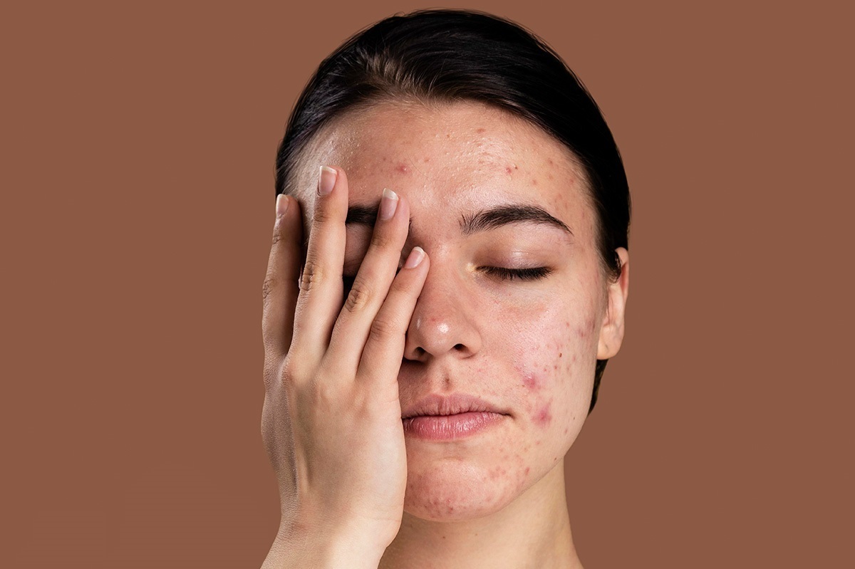 زنی که با یک دست نیمی از صورت پر جوش خود را پوشانده- جوش زدن صورت