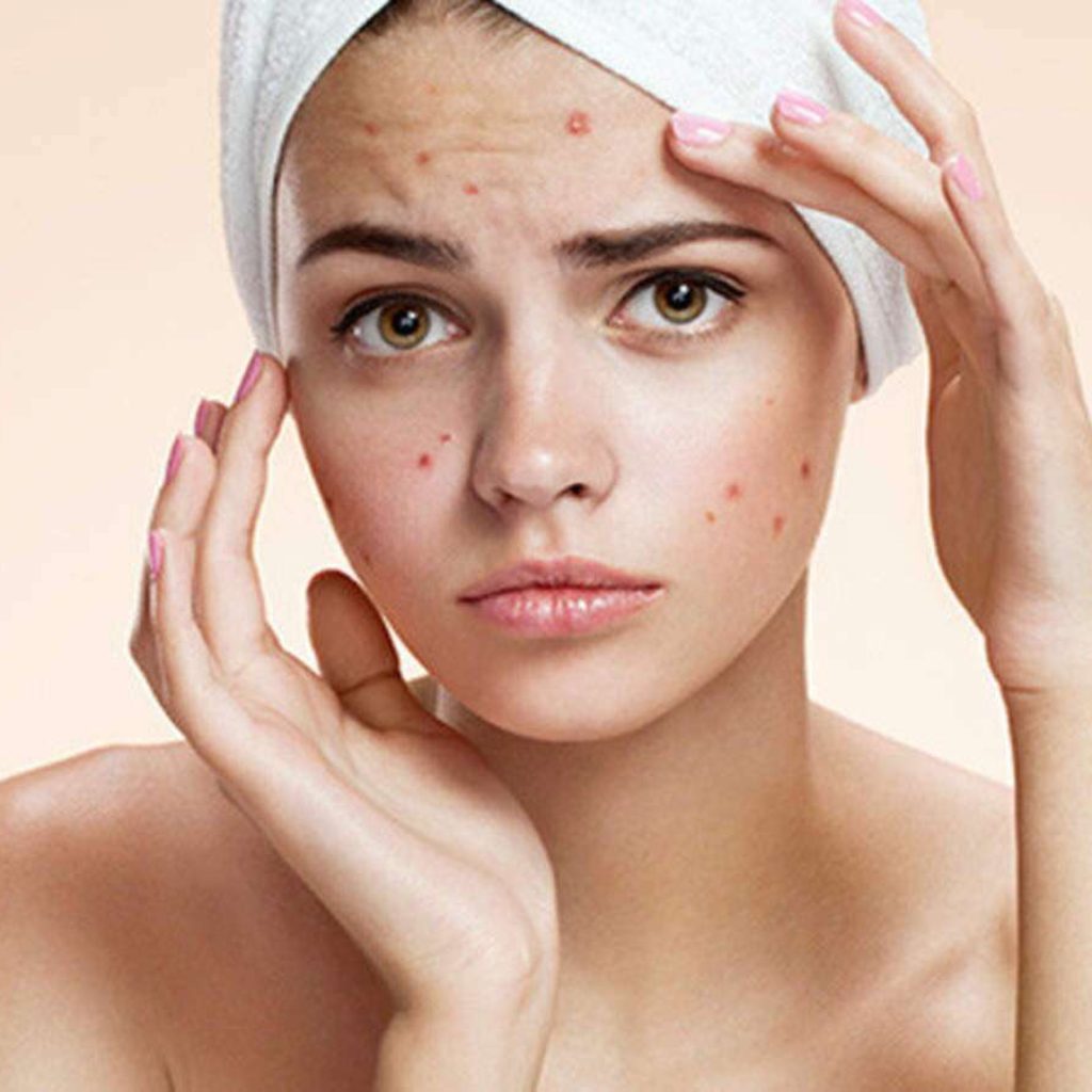 زنی با حوله سفید و صورتی پر از جوش- درمان جوش صورت