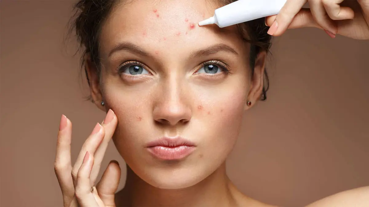 زنی با جای جوش - درمان فوری جای جوش