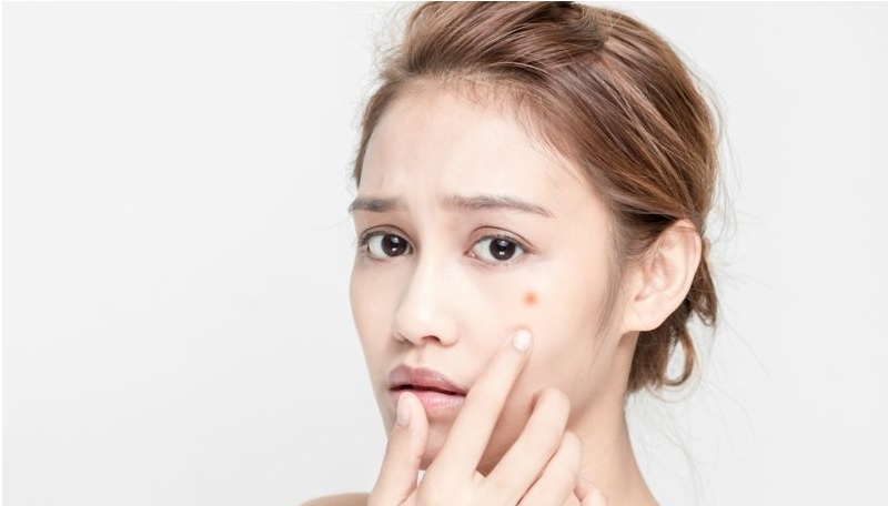 زنی با یک جوش قرمز روی گونه- جوش زدن صورت