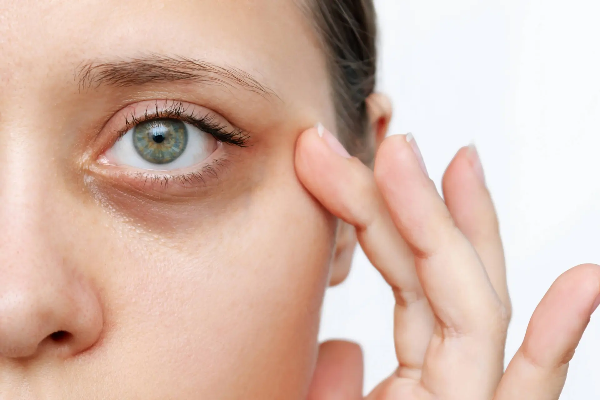 نیمرخ زنی با سیاهی دور چشم- رفع سیاهی دور چشم