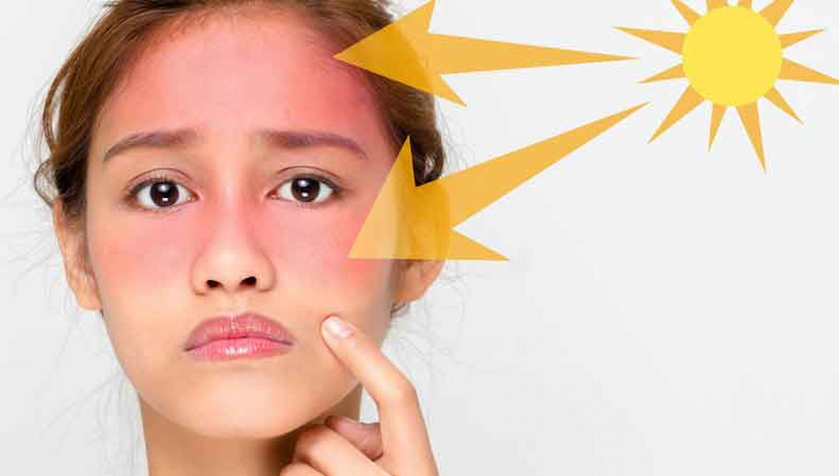 چهره زنی آفتاب سوخته- رفع سیاهی دور چشم