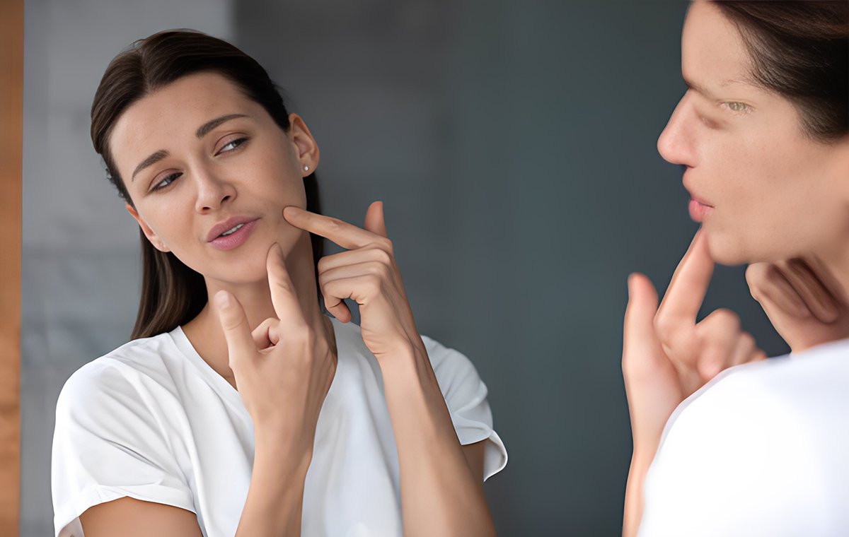 زنی با چهره آشفته از جوش صورت- جوش زدن صورت