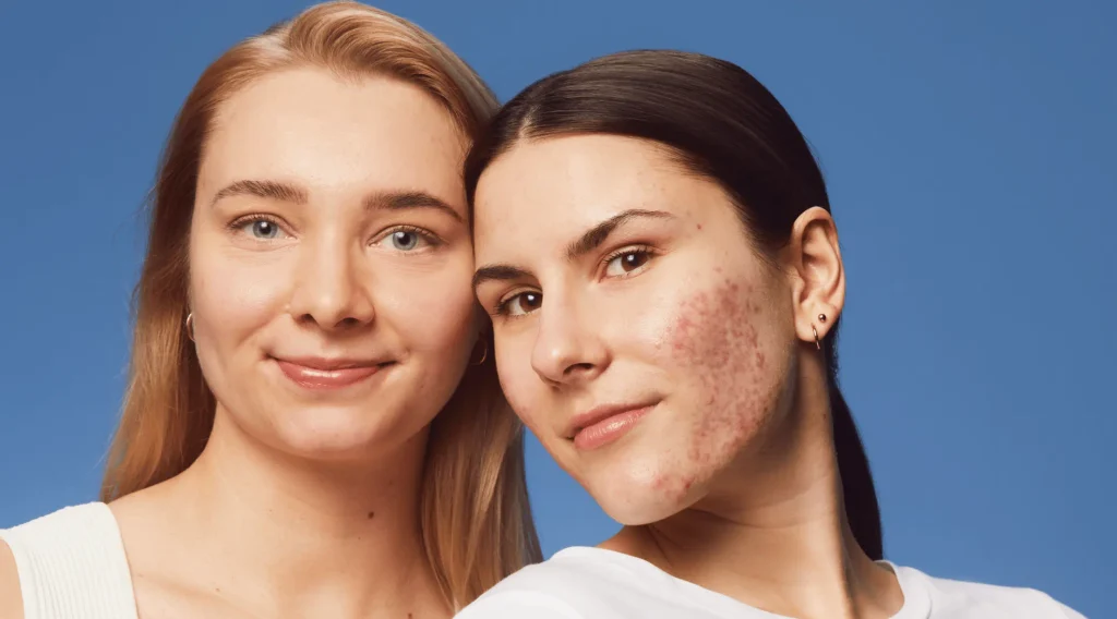 نحوه صحیح استفاده از کرم ضد لک؛ راهنمای کامل برای نتیجه سریعتر | فروشگاه اینترنتی آراویرا اشتباهات رایج در انتخاب کرم ضد لک