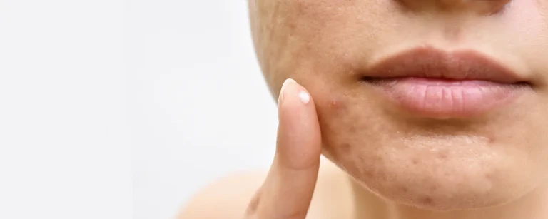 تفاوت میلیا و آکنه