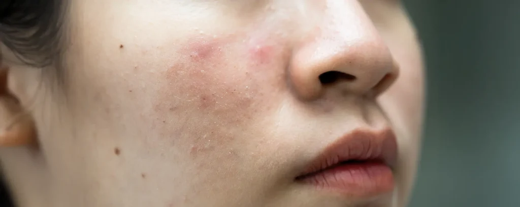 تفاوت میلیا و آکنه؛ تفاوتها، دلایل و بهترین روشهای درمان هرکدام | فروشگاه اینترنتی آراویرا روشهای درمان آکنه