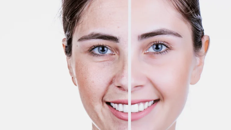 پوست کدر در آلودگی هوا