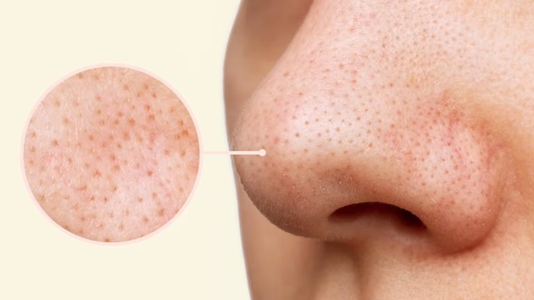 درمان جوش‌های سرسیاه